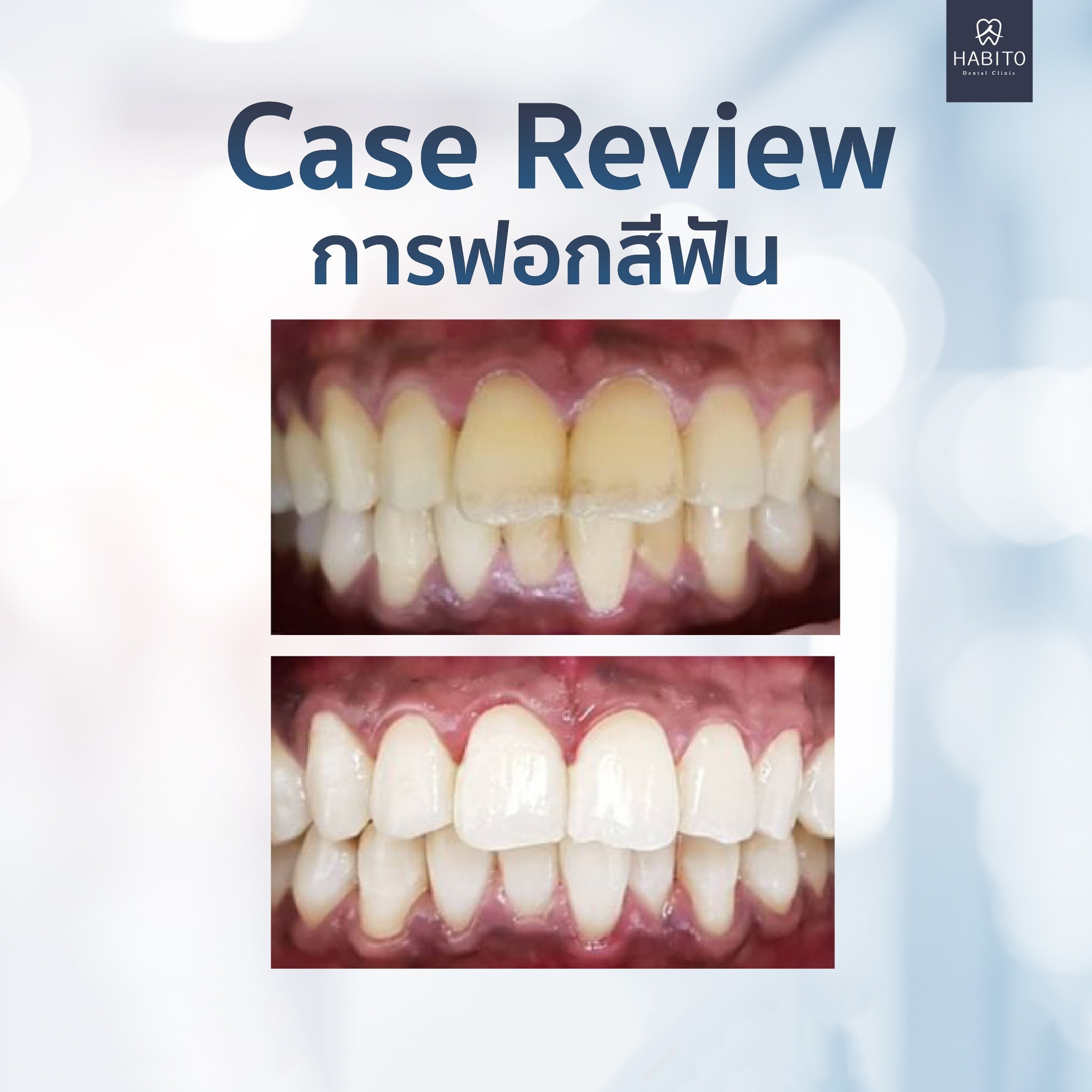 ตัวอย่างผลงานการฟอกสีฟันของ คลินิก Habito
