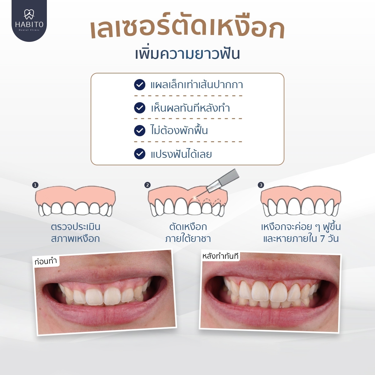 ตัวอย่างผลงานการทำเลเซอร์เหงือก ของ คลินิก Habito
